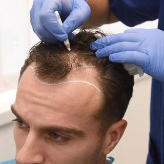 Hair Transplant Recovery: What to Expect in the First 6 Months