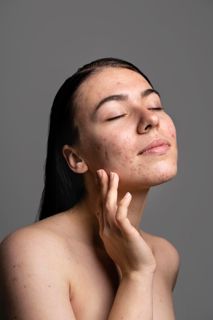 Combining Treatments for Acne: What Works in Dubai