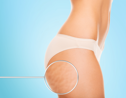 Choosing Between Cellulite Treatments