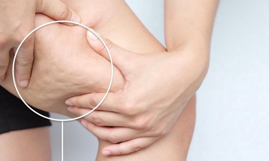 A Comprehensive Guide to Cellulite Treatments