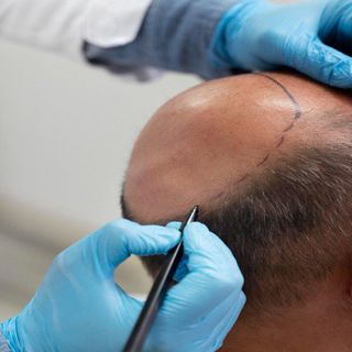 Best Hair Transplant Surgery Recovery: What You Need to Know for Optimal Results