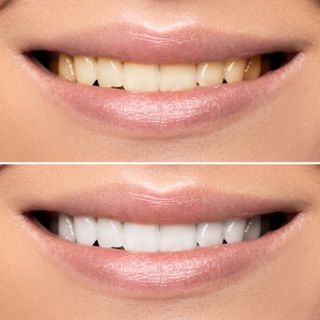 Affordable Teeth Whitening in Dubai Quality Treatments That Won't Break the Bank