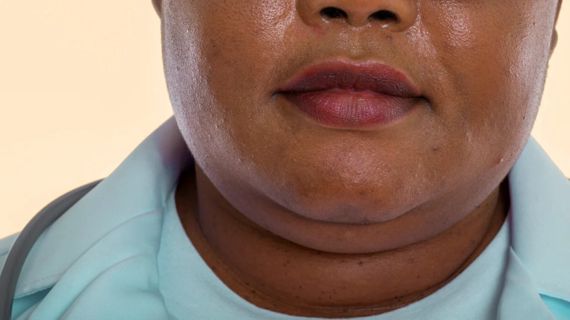 The Ultimate Guide to Double Chin Removal Treatments