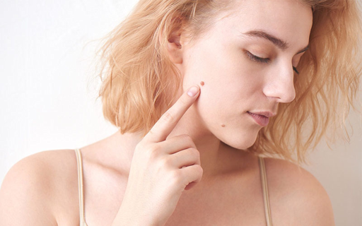 Mole Removal: Can You Use Sunscreen After Treatment?