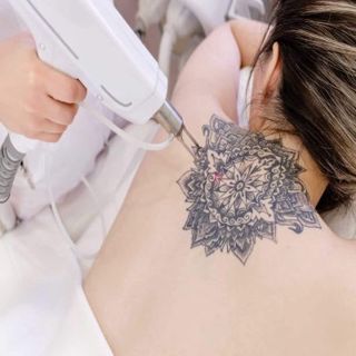 Understanding the Different Types of Lasers Used in Tattoo Removal