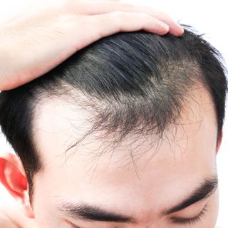 Finasteride for Men A UAE Perspective on Effectiveness and Safety