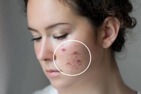 Rediscover Smooth Skin: Effective Acne Scar Treatments in Islamabad