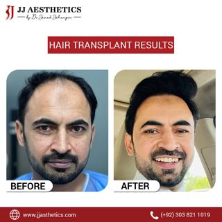 hair transplant doctor in Pakistan