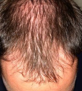 Hair Loss - Causes, Symptoms and
Treatment Options