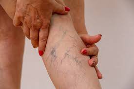 Is Varicose Veins Painful? Unveiling the Truth about Varicose Vein Discomfort