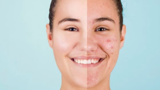 Skin Toxins And Waste is Major Cause Of Acne