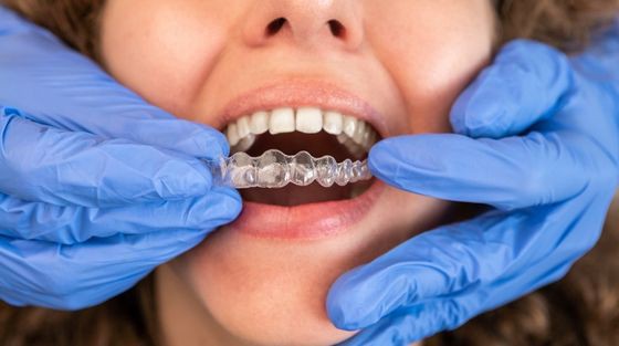 What are the Options Available for Teeth Alignment?