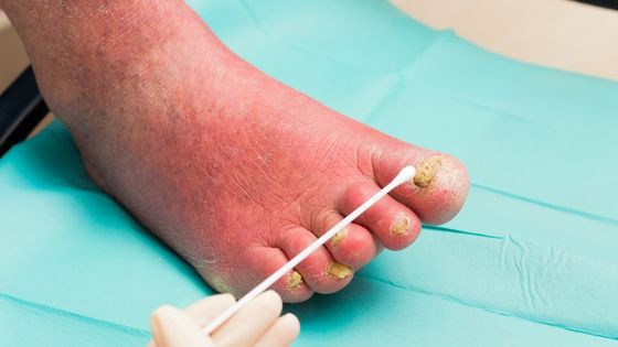 What are Signs of a Fungal Infection, and How Can You Treat It?