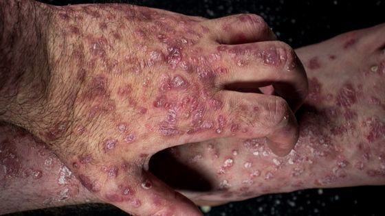 What is Psoriasis Disease and How to Treat This Condition?