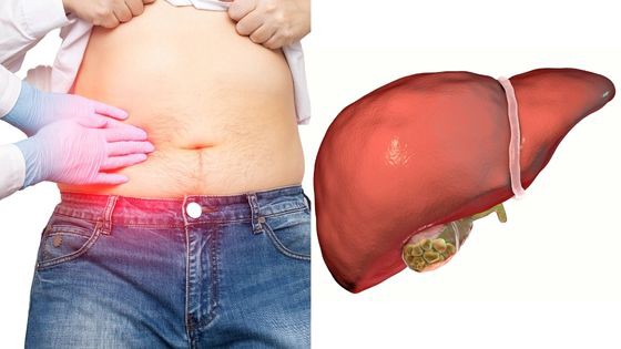 What Causes Gallstones and How to Manage Them?