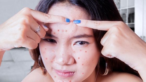 What Causes Acne Problems and How to Treat Them?