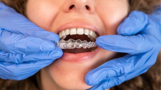 Make Your Smile Perfect Using Clear Aligners