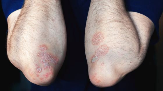 What Kind of Changes Comes in The Skin After Psoriasis?