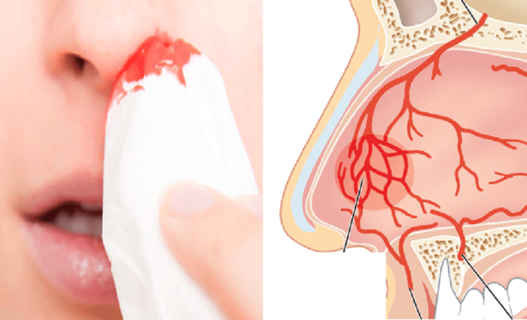 Ăn nhân sâm chảy máu mũi là bị gì? Có nguy hiểm tính mạng không?