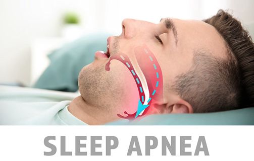 Sleep apnea and treatment