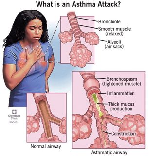 Navigating the Complex Landscape of Asthma: A Comprehensive Guide