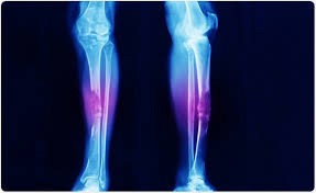 Doctors identify the early symptoms of bone cancer that most people ignore
