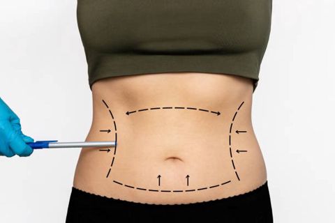 Confidence Starts Here: Liposuction in Riyadh