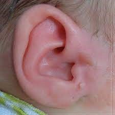 Your Path to Ear Elegance | Preauricular Tag Removal in Abu Dhabi